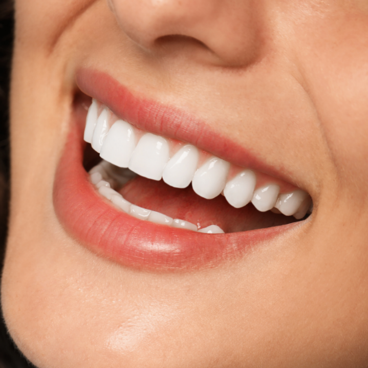 Smile Design / Veneers